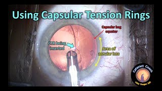 Using Capsular Tension Rings in Cataract Surgery with zonular loss [upl. by Nyloj296]