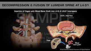 Decompression amp Fusion of Lumbar Spine at L4S1 [upl. by Kaja]