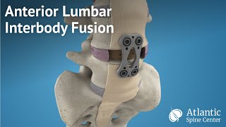 Anterior Lumbar Interbody Fusion ALIF [upl. by Ecinnej]