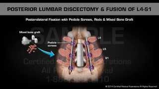 Posterior Lumbar Discectomy amp Fusion of L4S1 [upl. by Pris]