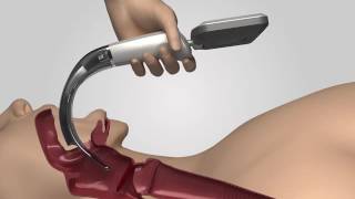 Video Laryngoscope iS3 L training video [upl. by Epilif367]