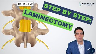 Step by step how to perform a lumbar laminectomy [upl. by Atteloj733]