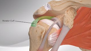 Superior Capsular Reconstruction [upl. by Yks]