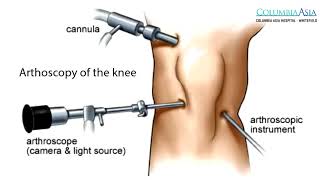 How long does it take to recover from Arthroscopic Knee Surgery [upl. by Randee]