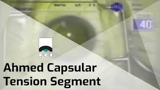 Ahmed Segment  Capsular Tension Segment  Features amp Procedure  FCI Cataract [upl. by Nalehp]