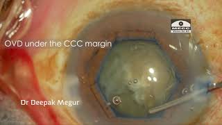 Capsule Tension Ring CTR  Part 2 Implantation technique tips amp tricks Dr Deepak Megur [upl. by Olbap]