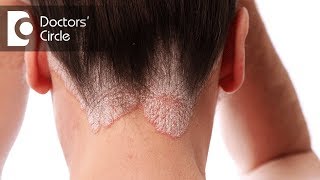 Will psoriasis cause hair fall  Dr Leelavathy B [upl. by Alahsal]