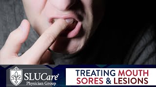 Determining Causes amp Treatment for Canker Sores  SLUCare Otolaryngology [upl. by Stu]