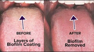 White tongue  3 Reasons for the White Coating on Your Tongue and What to Do About It 1 [upl. by Lamond]