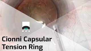 Cionni CTR  Capsular Tension Ring  Presentation  FCI Cataract [upl. by Gaultiero]