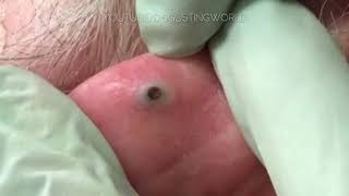 Largest Earring hole blackhead ever [upl. by Jauch]