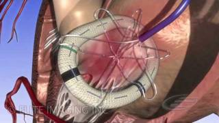 Mitral Heart Valve Ring  Medical amp Scientific Video Production [upl. by Portugal]