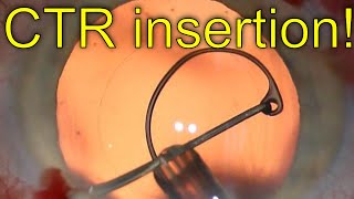 Capsular tension ring  atraumatic insertion technique with Sinskey hook  Dr Simon Chen 1080p HD [upl. by Einafpets833]