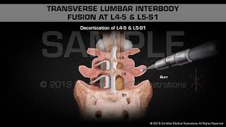 Transverse Lumbar Interbody Fusion at L45 amp L5S1  Medical Animation [upl. by Suoivart]